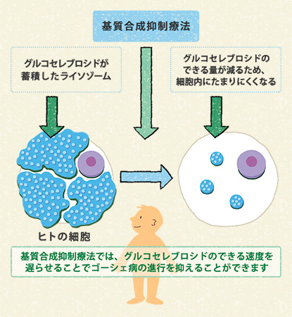 図4　ゴーシェ病の基質合成抑制療法