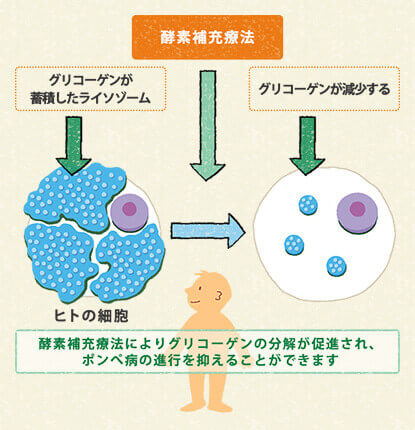 図2　ポンペ病の酵素補充療法