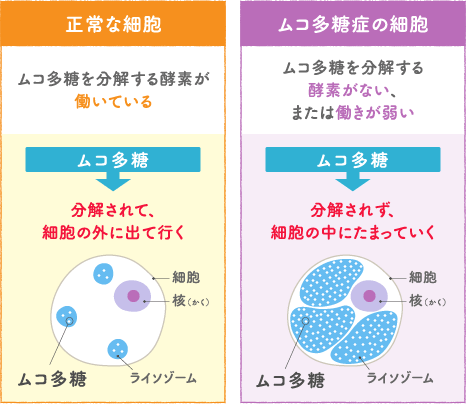 みんなに知ってほしい ムコ多糖症 ライソゾーム病サイト ライソライフ ムコ多糖症